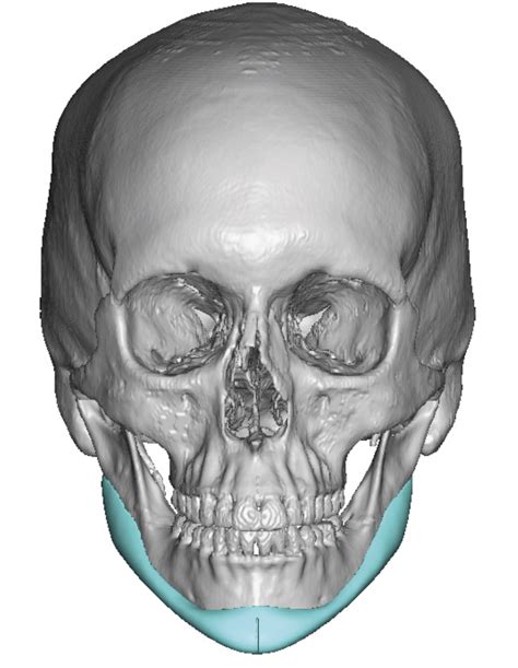 Plastic Surgery Case Study Custom Jawline Implant For Female Subtotal