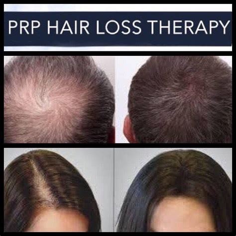 Top 5 Benefits Of PRP Hair Restoration A Better You