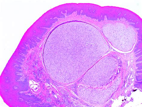 Scanning Microscopy Demonstrating A Multinodular Lesion In The Stroma