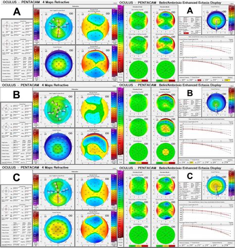 Corneal Biomechanical Properties To Predict Prognosis Of Abnormal