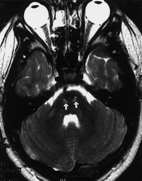 Childhood X Linked Adrenoleukodystrophy Clinical Pathologic Overview