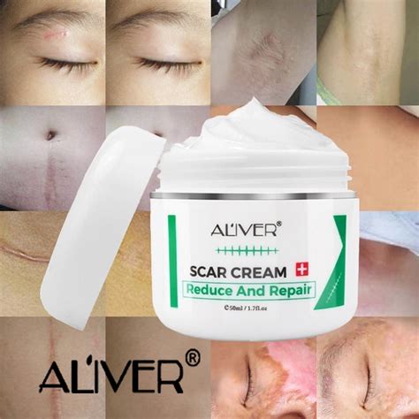 Aliver Scar Cream Old Scar Removal Gel Repair Stretch Marks Pimple