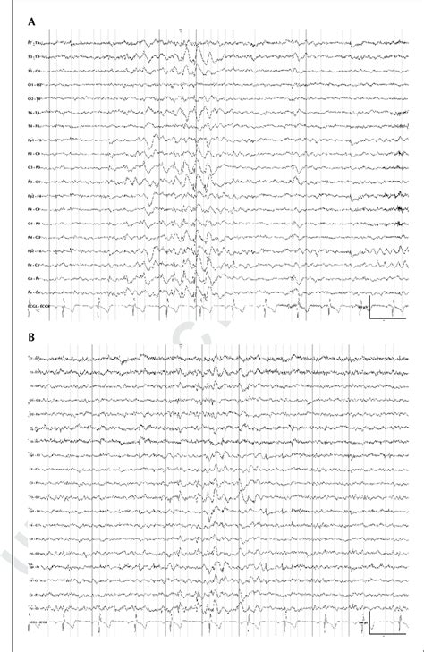 Eeg Of Patient 1 Showing A 3 Hz Generalized Spike Wave Gsw