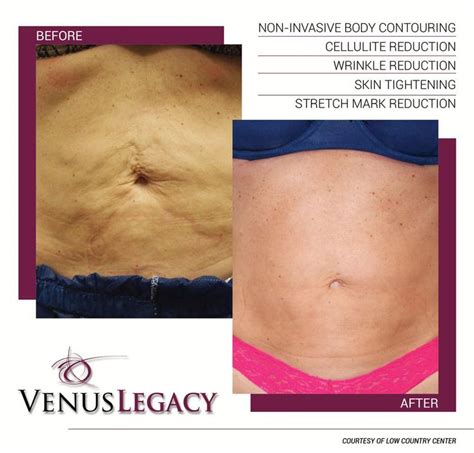 7 best sono bello images on Pinterest | Venus, Body contouring and Medical aesthetics