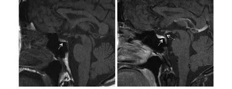 T1 Weighted Sagittal Pituitary Mri Of The Patient The Images Are