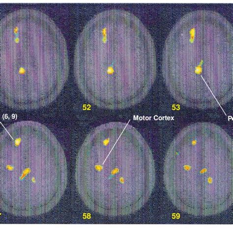 Statistical Parametric Map Overlaid On A Magnetic Resonance Image