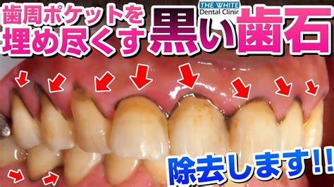 【歯石】歯周ポケットを埋め尽くす黒い歯石を除去します Youtube