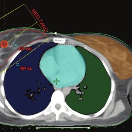 Patient Anatomy Showing Breast Planning Target Volume PTV And OARs