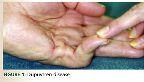 Figure 1 from What is the appropriate treatment for Dupuytren ...