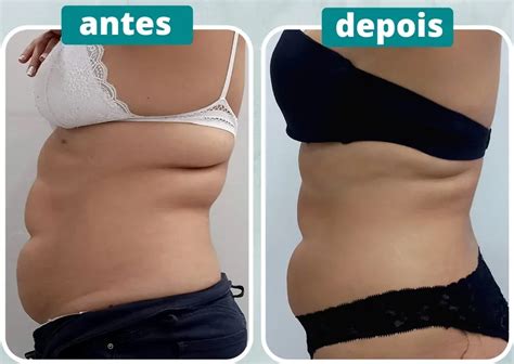 Hidrolipo Antes E Depois