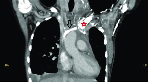 Computed Tomography Angiographic Image Of The Persistent Left Superior Download Scientific