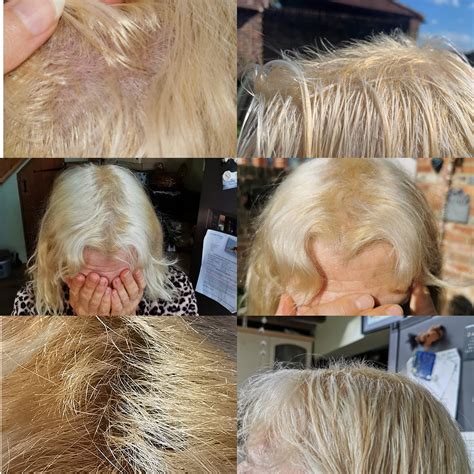 Top 103 Scalp Burning While Dying Hair Polarrunningexpeditions