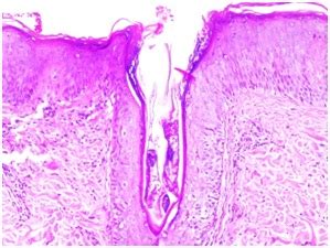 Demodex Folliculitis of the Scalp: Case Report