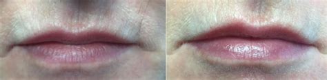 Lip Enhancements Victoria Park Medispa Winnipeg Manitoba Canada