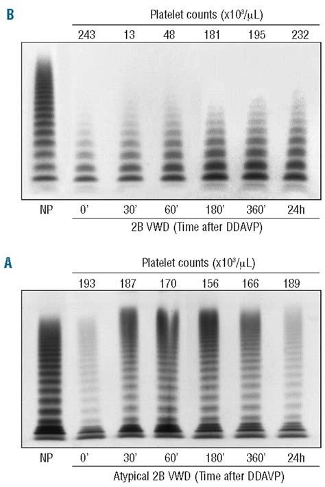 Reduced Survival Of Type 2b Von Willebrand Factor Irrespective Of Large Multimer Representation