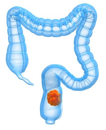 Colorectal Cancer Ncp