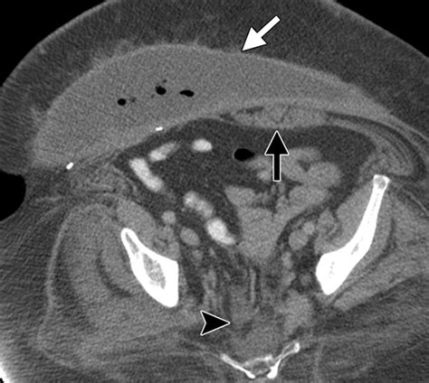 Pelvic Reconstruction With Omental And VRAM Flaps Anatomy Surgical