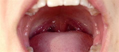 What Are Tonsil Stones And What Do I Do About Them Dr Rotenberg