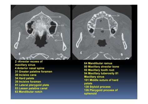 2 Alveolar Recess Of Max