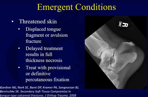 Calcaneal Fracture Emergency Treatment —