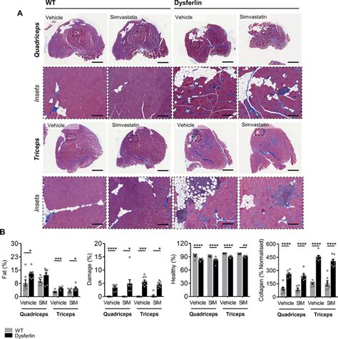 Simvastatin Did Not Attenuate LGMD2B Associated Quadriceps Or Triceps