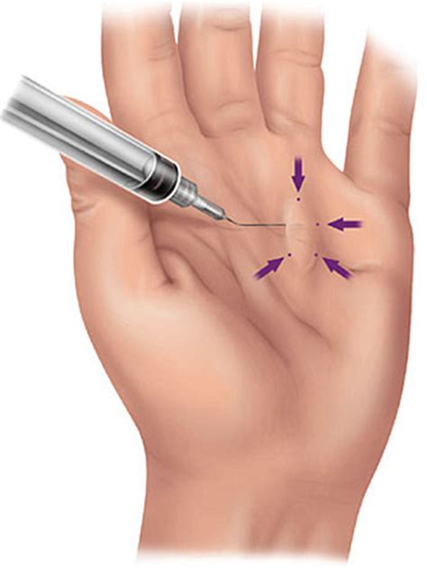 Dupuytren S Contracture Causes Symptoms Treatment