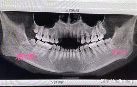 南方医科大学口腔医院（广东省口腔医院）拔牙记 知乎