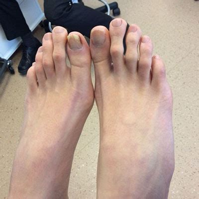 Before And After A Definitive Ingrown Toenail Procedure Ottawa Foot