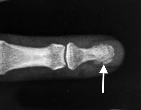 Finger Distal Phalanx Fractures Hand Surgery Resource