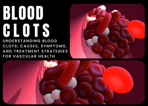 Blood Clots Causes Symptoms And Treatment Boundless Home Health