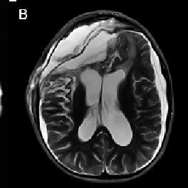 MRI A A T1W Axial B B T2 Axial C C T1W Gadolinium Enhanced