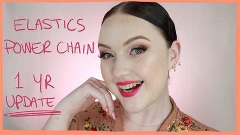 Adult Braces 1year Update Elastics Powerchain Youtube