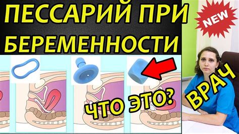 Пессарий при беременности, что это такое. Отзыв врача. Когда ставят и ...