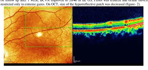 Figure From Toxoplasma Retinochoroiditis With Involvement Of Nd And