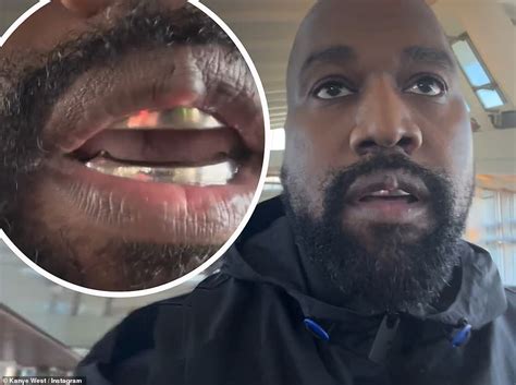 Kanye Displays Worrying Growth On His Lip After Getting Titanium Teeth