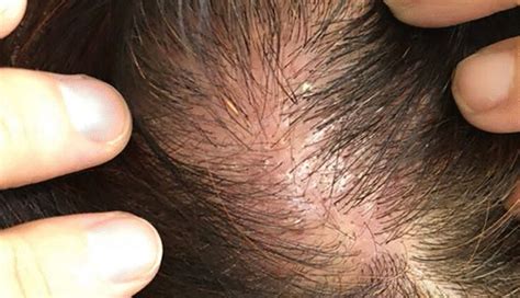 How To Treat Scabs On The Scalp