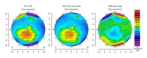 Update On Corneal Crosslinking And Topography Guided Prk In 41 Off