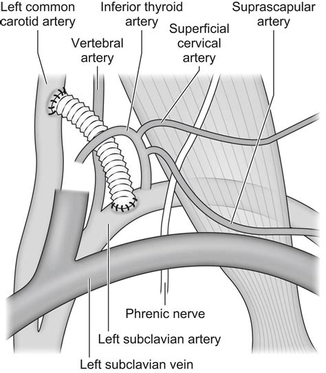 Thoracic And Thoraco Abdominal Aortic Disease Clinical Tree