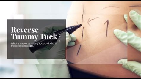 Reverse Tummy Tuck Youtube