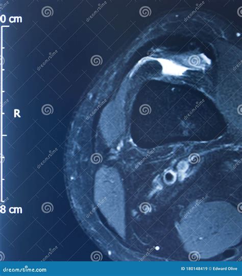 Knee injury mri mcl tear stock image. Image of joint - 180148419