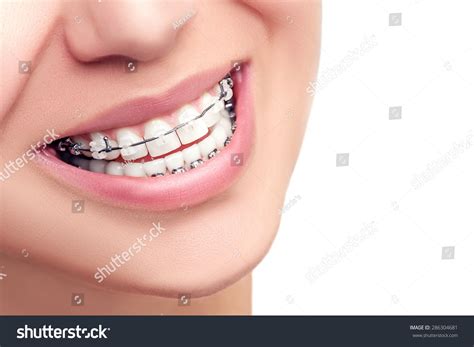 3,613 Perfect smile braces Images, Stock Photos & Vectors | Shutterstock