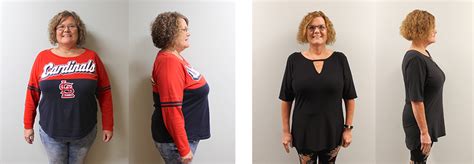 Tracy S Gastric Sleeve Success St Louis Bariatrics