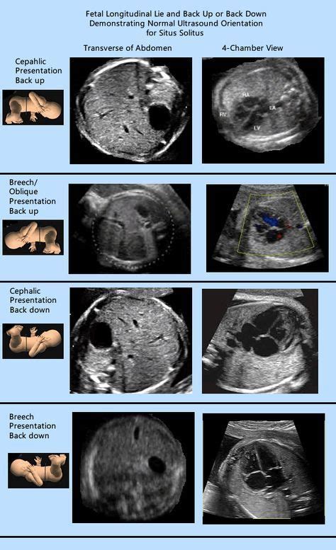 presentation in ultrasound