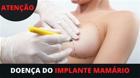 DOENÇA DO IMPLANTE MAMÁRIO Silicone Sintomas Tratamento