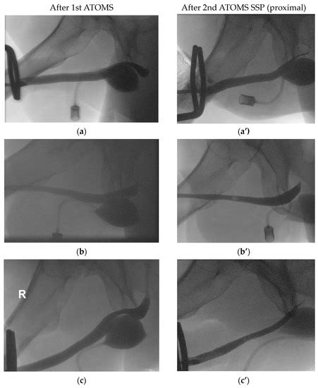 Jcm Special Issue Prostate Cancer Treatment Options And Its