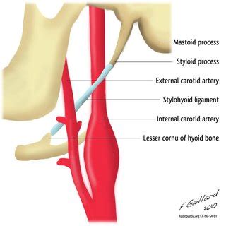 EAGLE SYNDROME AND INTERNAL CAROTID ARTERY DISSECTION DESCRIPTION OF 5