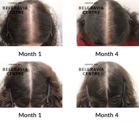 Hair Loss Success Story After 3 Months Of Treatment I Was Able To See Great Results