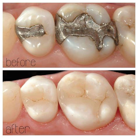 Composite Fillings Radlett White Fillings Cosmetic Dentist