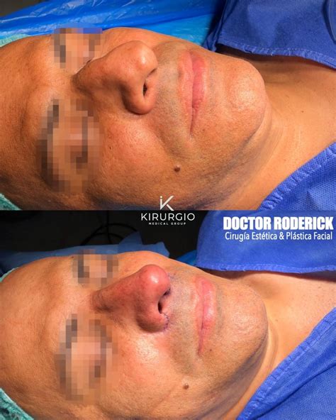 Rinoplastia Barcelona Kirurgio Medical Center