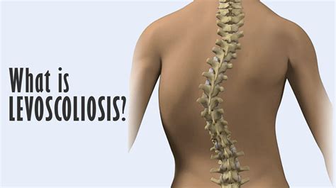 Levoscoliosis Definition Causes Symptoms And Treatment